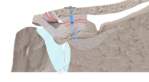 Physiotherapy Acromioclavicular joint (ACJ) stabilisation leaflet